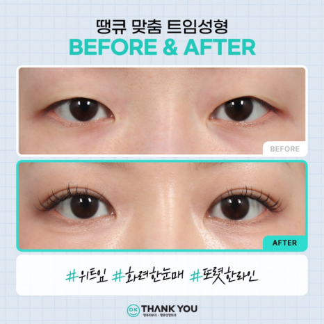 트임성형잘하는곳에서 알려주는 트임 위치별 특징 관련 이미지 5