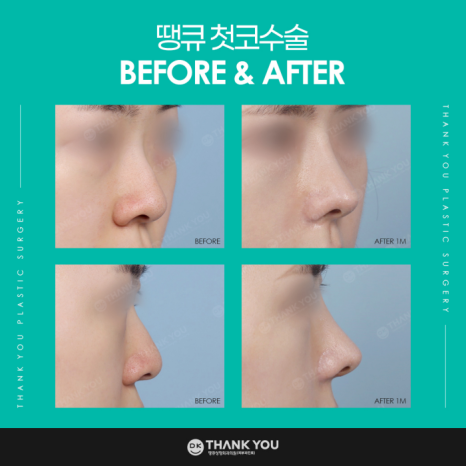 첫코수술 성공을 위해 고려해야 할 점은? 관련 이미지 7