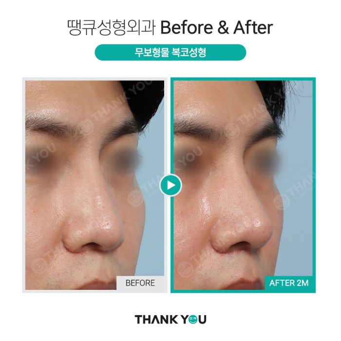 첫코성형, 자연스러운 결과를 원한다면?! >> 무보형물코성형 관련 이미지 10