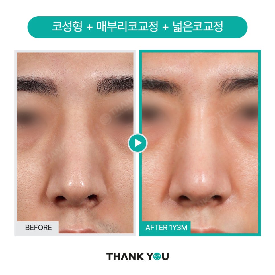 신논현역 성형외과, 남자 휜코성형, 매부리코 성공 포인트는? 관련 이미지 7