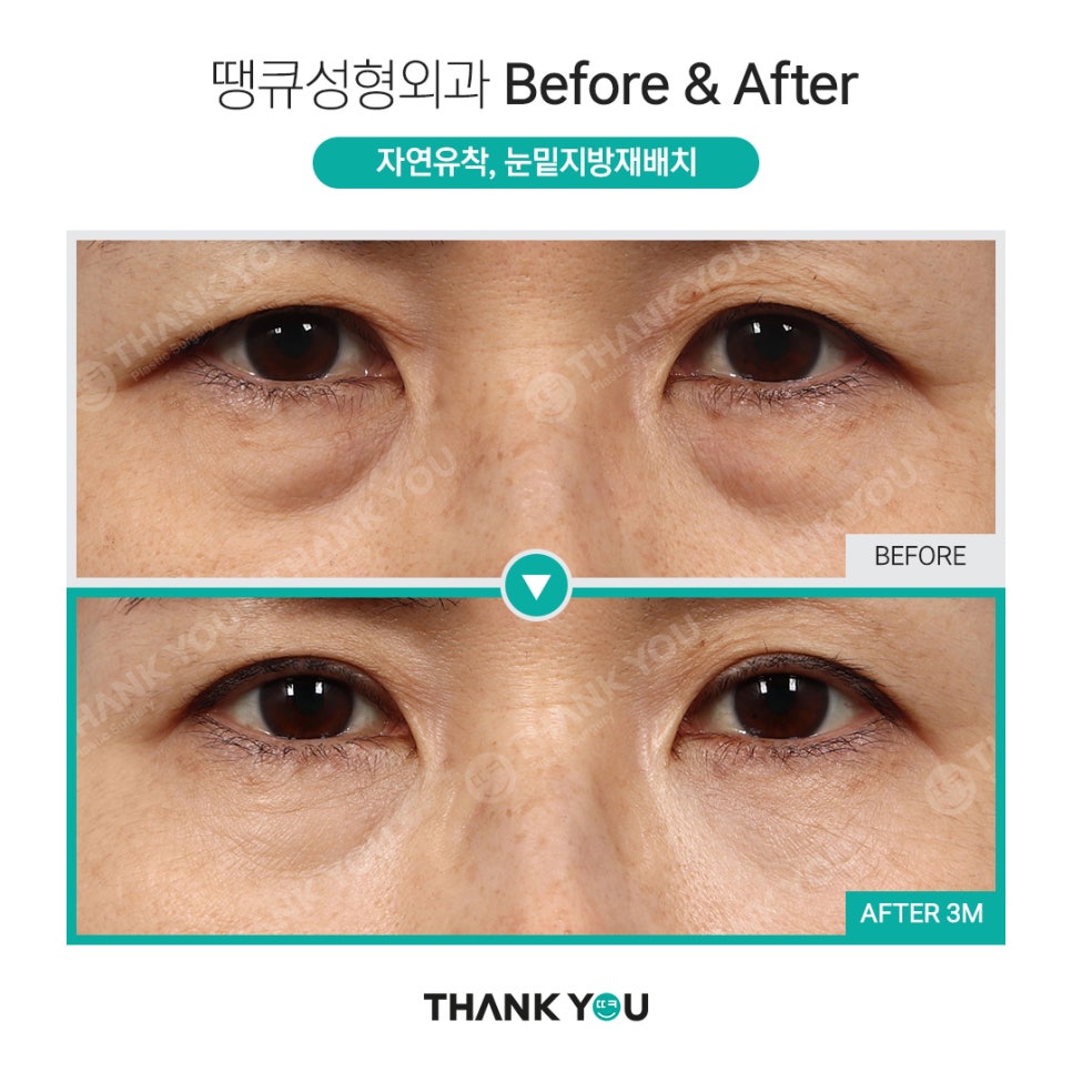 눈밑 필러 넣었는데 눈밑지방재배치 가능할까요? (이호준 칼럼) 관련 이미지 15