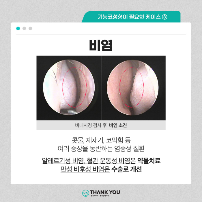 기능코수술병원에서 콧 속 불편함, 외적 스트레스 동시 해소! 관련 이미지 8