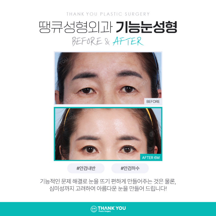 기능눈성형 근본적인 원인을 개선해야 해요! 관련 이미지 5