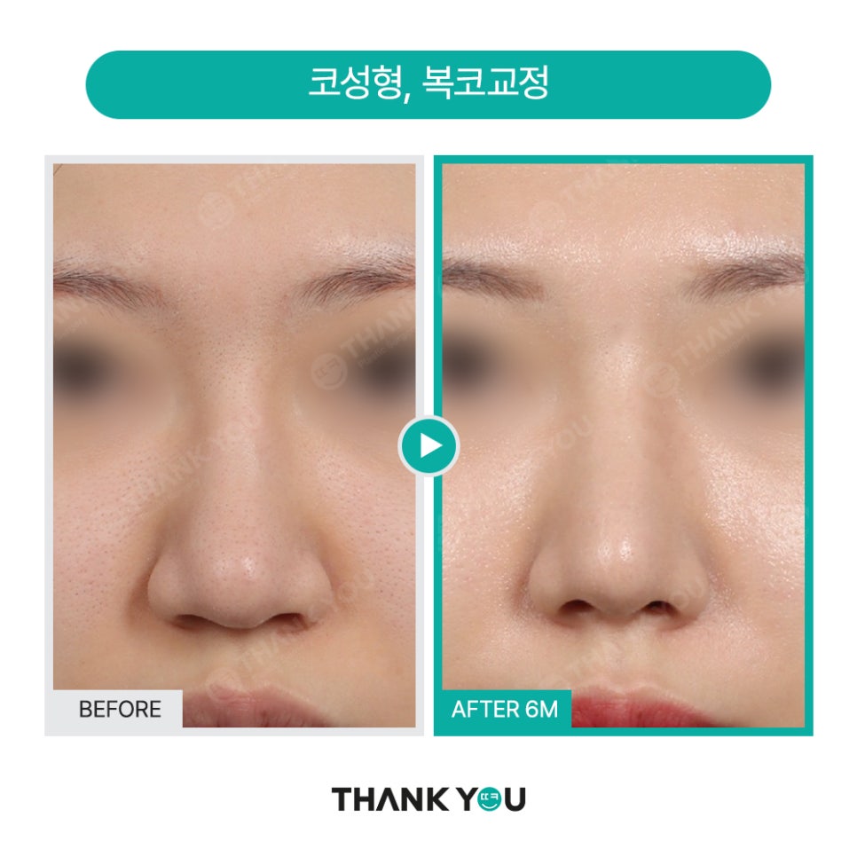 코성형, 비공내리기 수술이란? [콧구멍 잘 보이는 용코 개선] 관련 이미지 6
