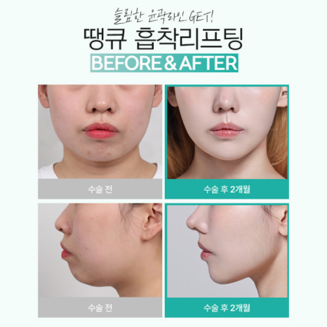 땡큐성형외과 이벤트 : 얼굴윤곽라인 개선엔?! 흡착리프팅 관련 이미지 10