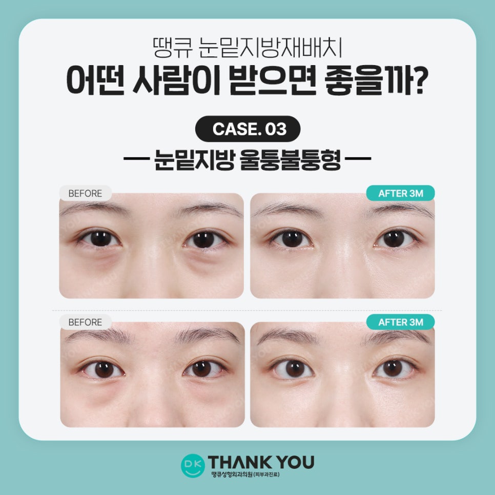 Under-Eye Fat Repositioning Event! Special Benefits for Exam Takers Prepared by Thank You 💫 image 6