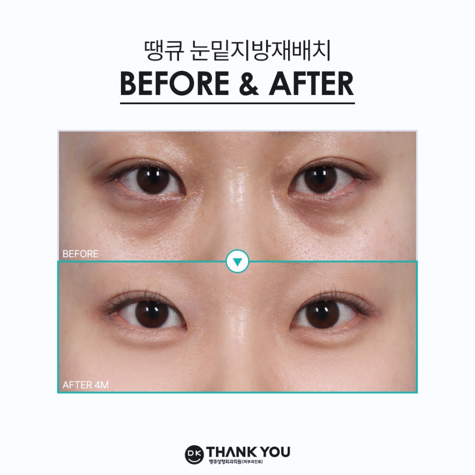 눈밑지방재배치 사시 부작용 궁금증 해소해 드립니다! 관련 이미지 12