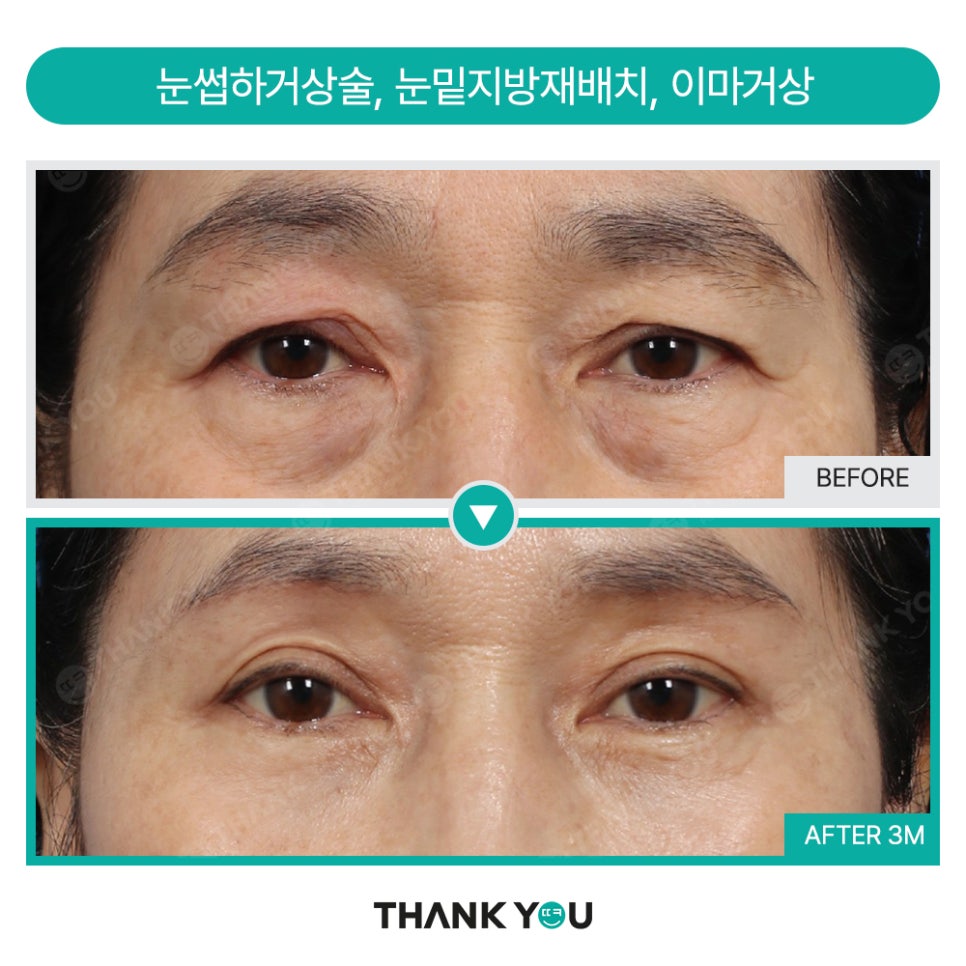 쌍꺼풀수술 없이 처진 눈 해결? [중년 이마거상/ 눈썹하거상술] 관련 이미지 6