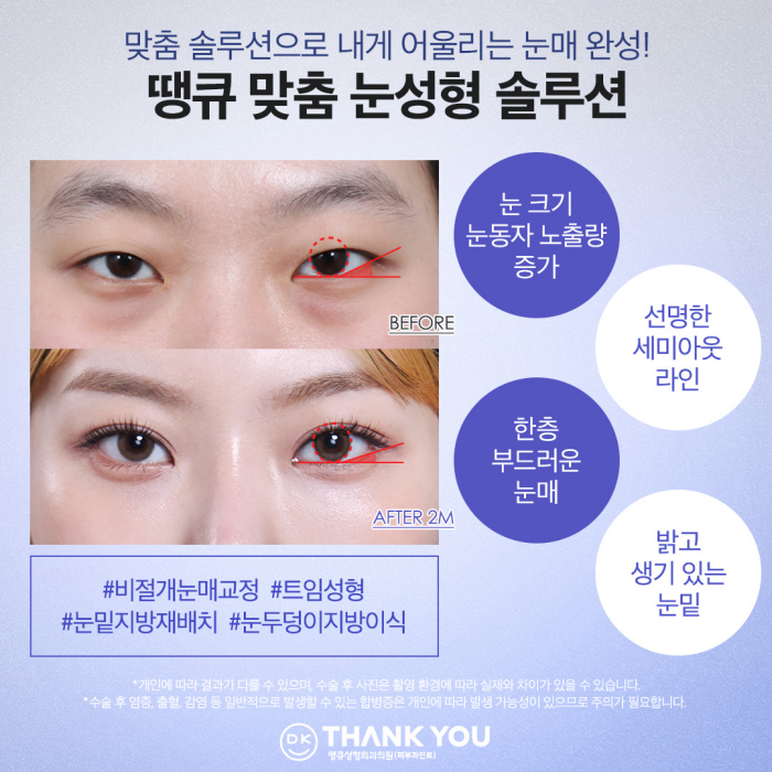 Improving Small, Faint Eyes with Non-Incisional Eye Correction Surgery ✨ (Make Me Girl Episode 7 Thank You Solution) image 5