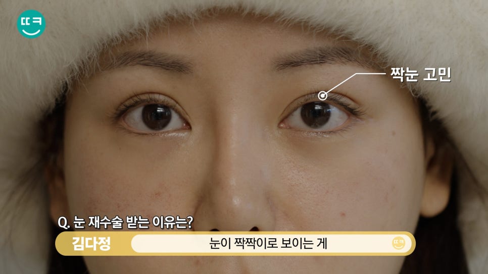 짝눈 쌍수 재수술, 짝짝이 라인과 비대칭쌍꺼풀 대칭 맞추기 관련 이미지 5