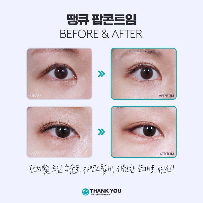 뒤밑트임 수술로 눈의 크기는 물론 이미지 개선까지! 관련 이미지 6