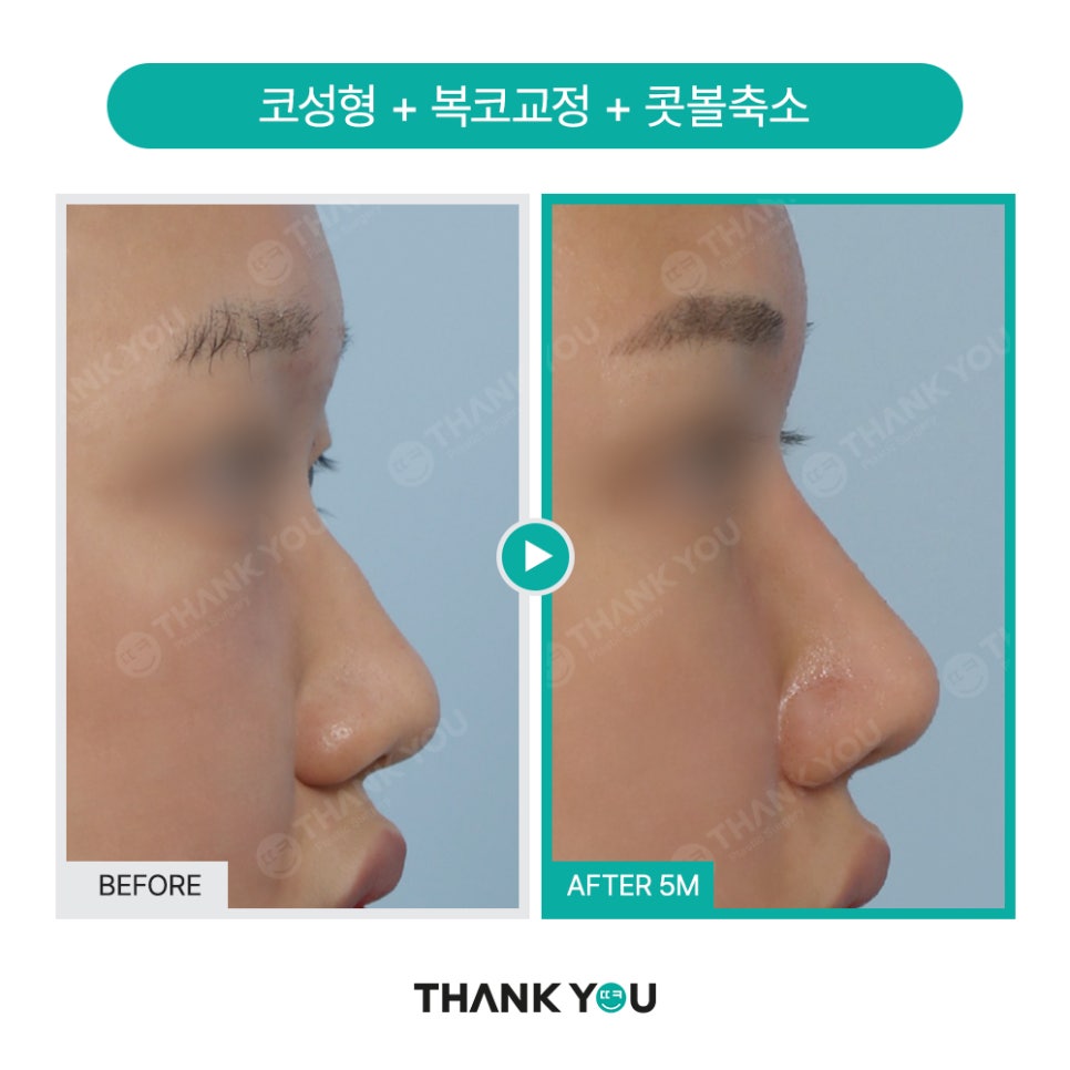 코성형 아직도 L자보형물? 실리콘 선택 기준은? 관련 이미지 12