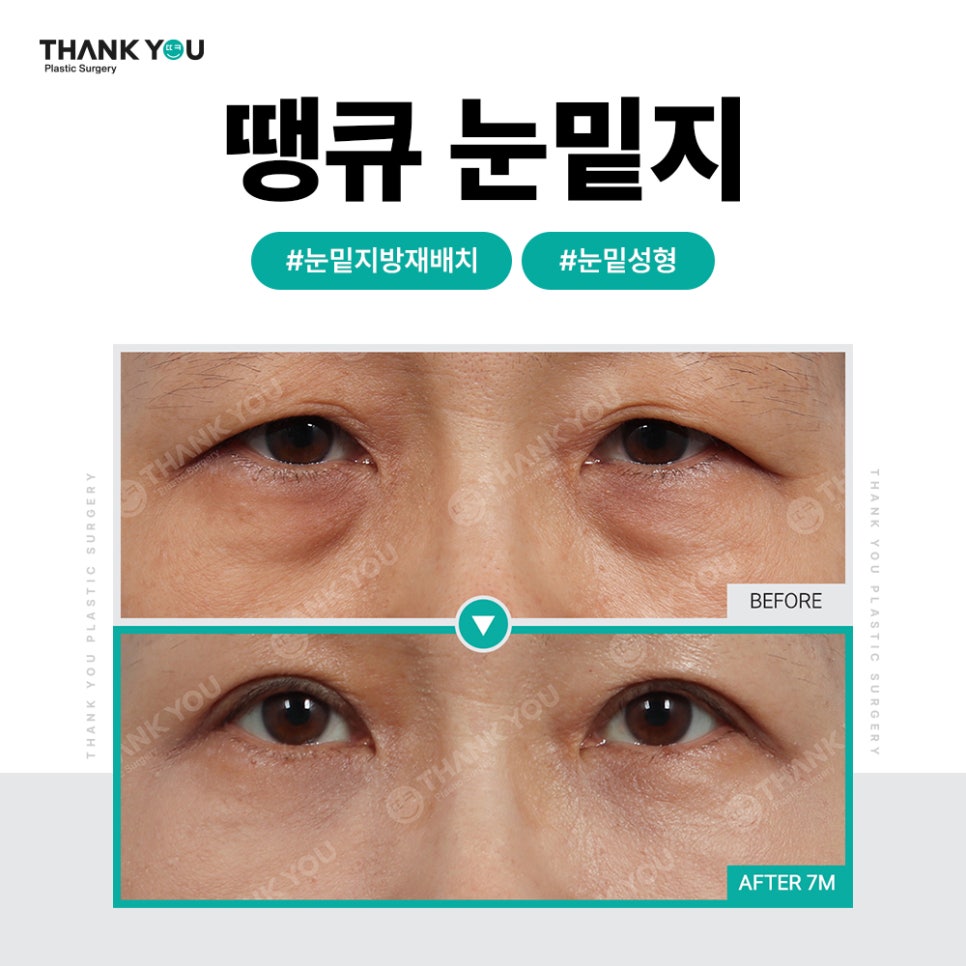 눈밑 불룩, 눈밑지 대신 눈밑지방제거만 단독으로? 관련 이미지 11