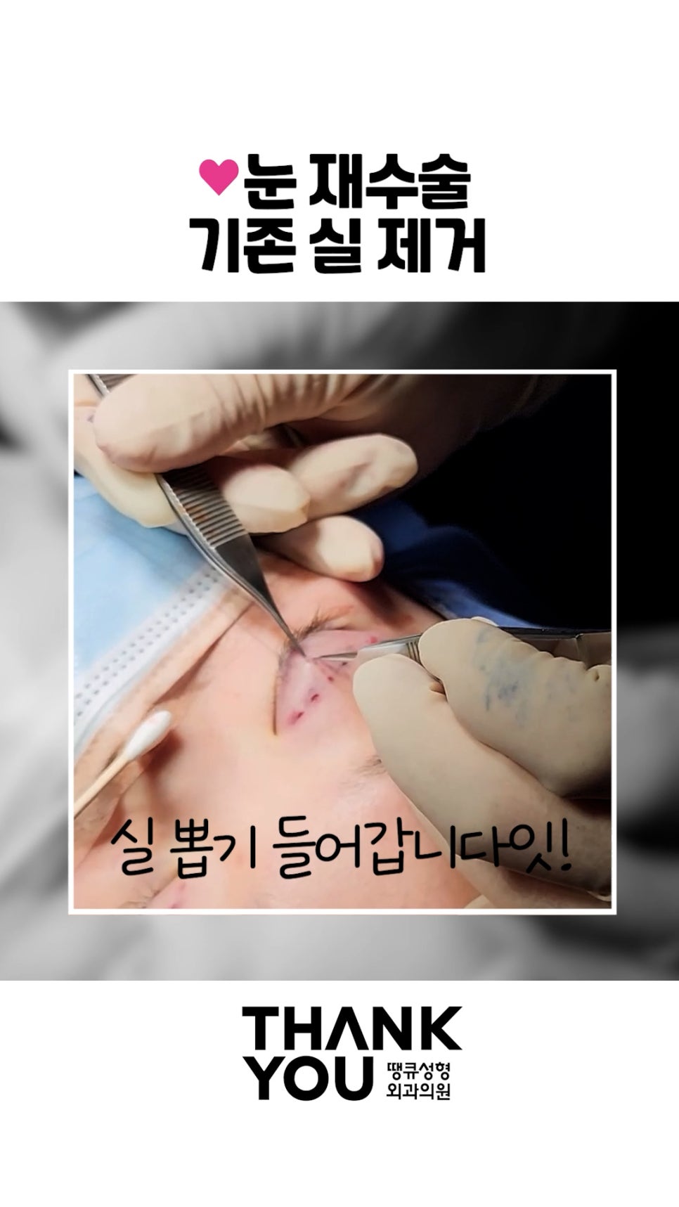 매몰 풀기, 매몰 실 제거 (15년 묵은 실)재수술 쌍꺼풀 관련 이미지 2