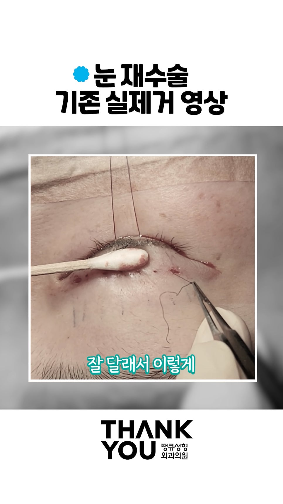 쌍수 풀기 (재수술전 실풀기+ 눈재수술 전후) 관련 이미지 8