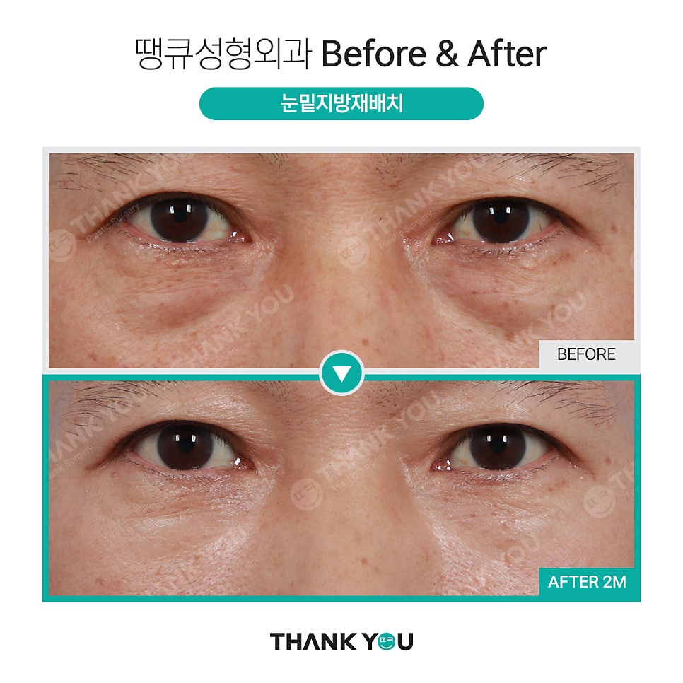 눈밑수술, 눈밑지방이식도 가능한가요? 관련 이미지 8