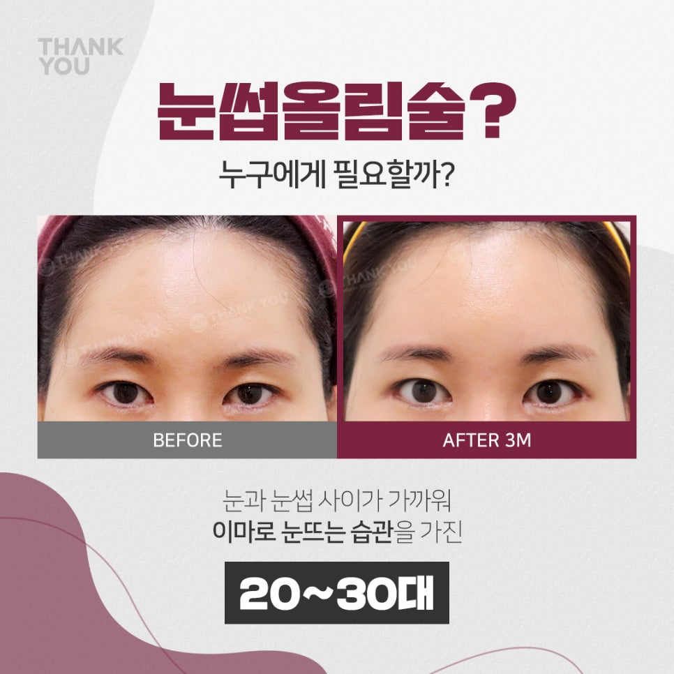 엔도타인 이마거상 찾는다면?시니어&주니어 눈썹올림술 관련 이미지 2