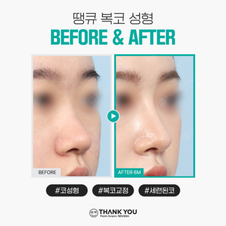 복코성형, 꼭 코뼈절골을 해야할까요? 관련 이미지 10
