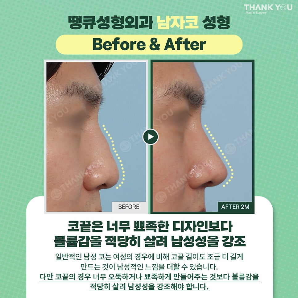 남자코성형 전후 비포애프터&T존 뚜렷한 직선 디자인으로 관련 이미지 5