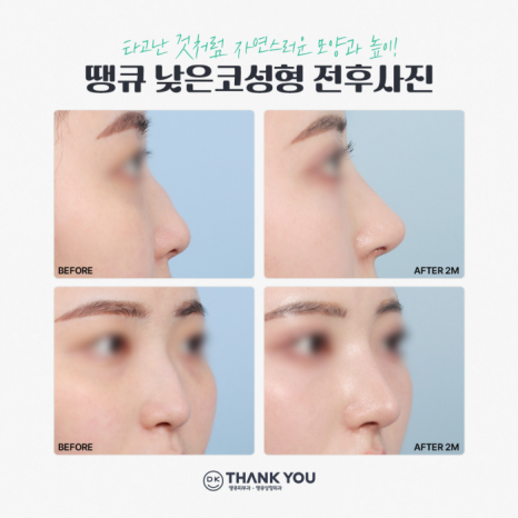 낮은코성형 내게 맞는 높이와 모양으로 관련 이미지 5