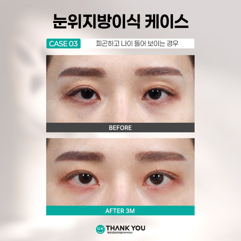 눈꺼풀꺼짐 개선하려면? 꺼진눈지방이식 전에 알아야 할 3가지 관련 이미지 6