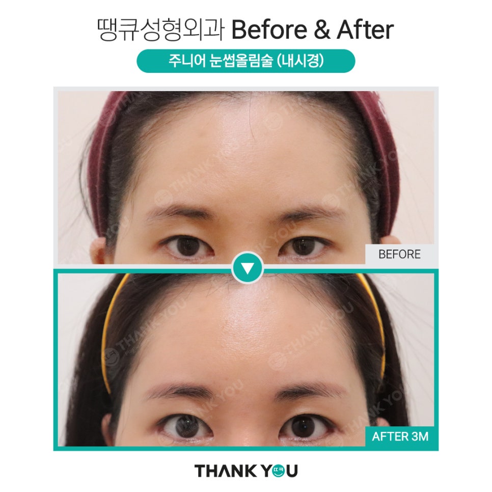 나이가 어린데도 이마거상을 꼭 해야 할까요? 관련 이미지 9