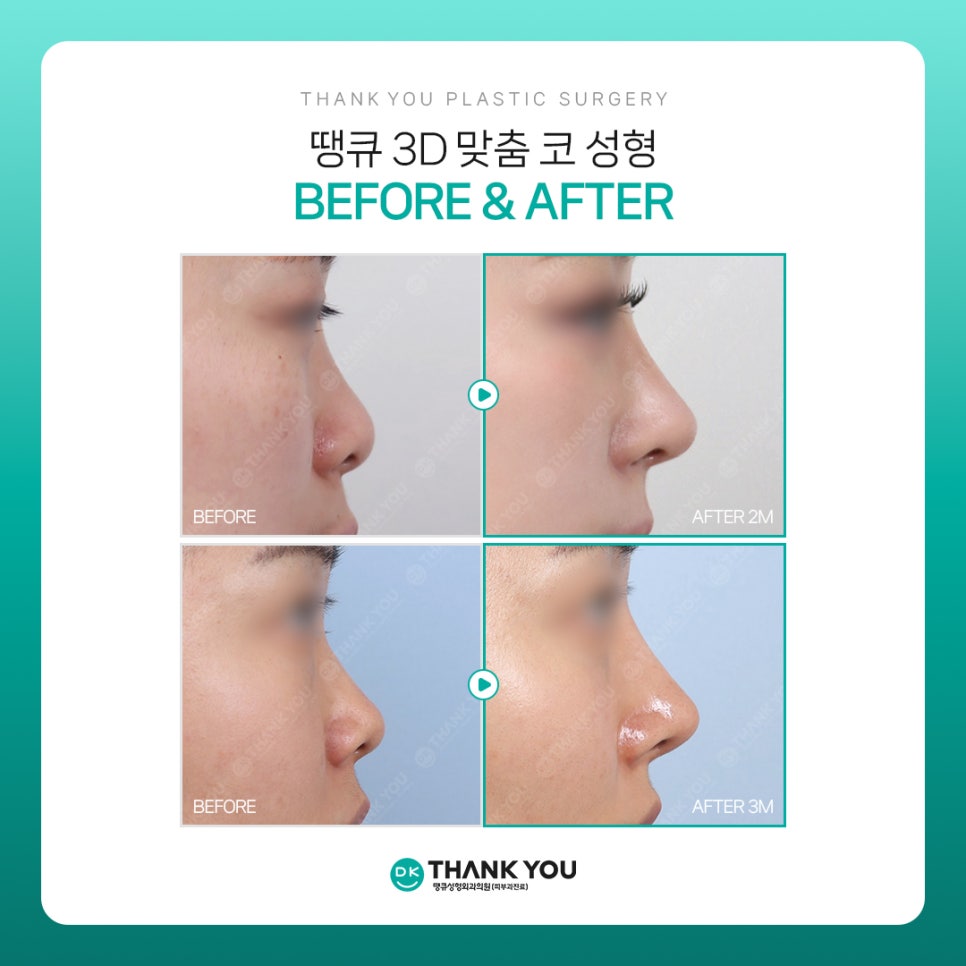 코성형전후, 만족스러운 차이를 얻고 싶다면?! 3D 맞춤 보형물 주목! 관련 이미지 8