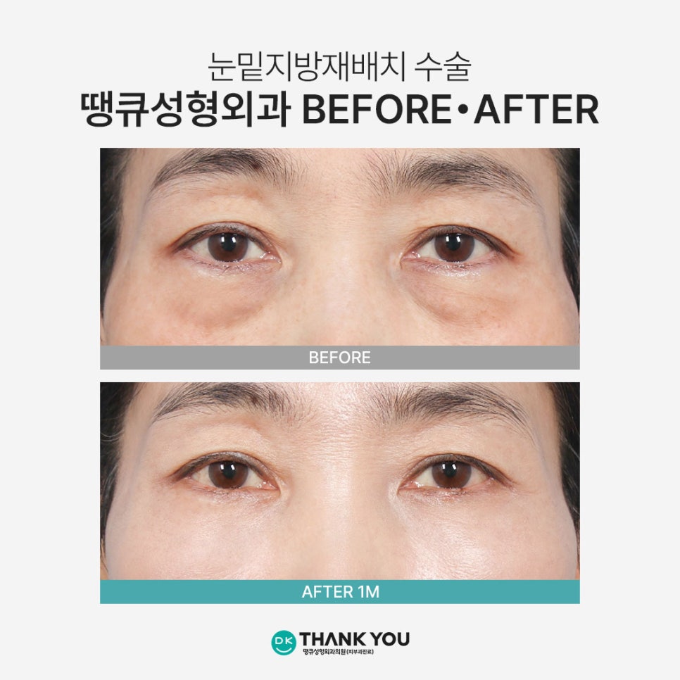 눈밑지방재배치 재발? 수술 후 눈 밑이 볼록한 이유 관련 이미지 6