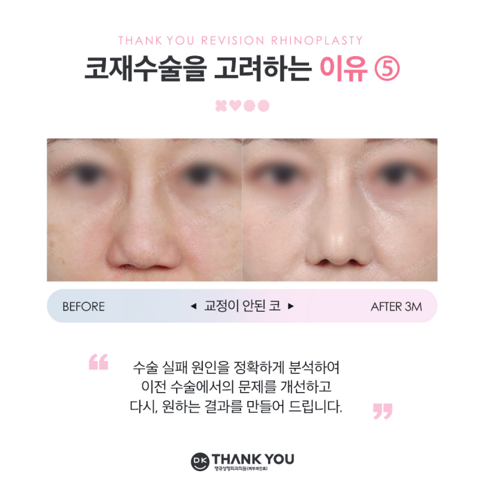 코재수술잘하는병원 땡큐 이벤트✨ 관련 이미지 6