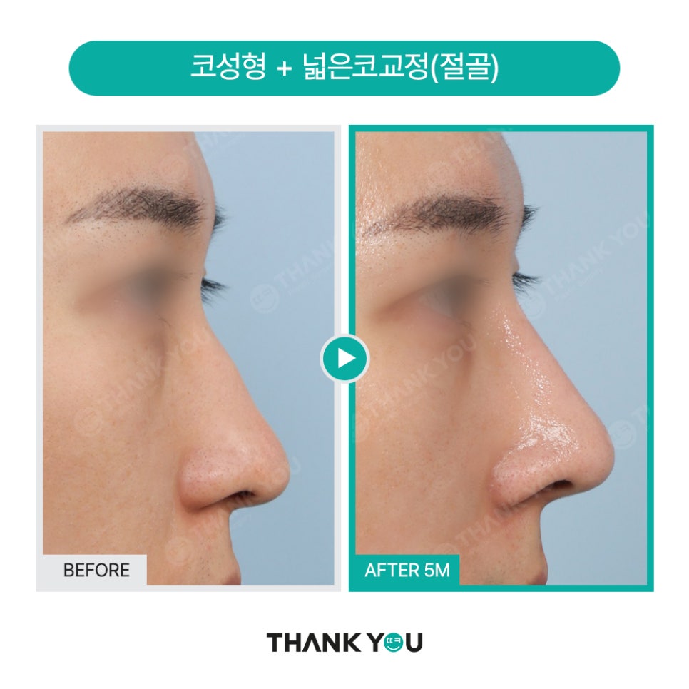 남자코성형 (휜코, 매부리코 등) 기능코성형 필요! [ft.코수술전후] 관련 이미지 21