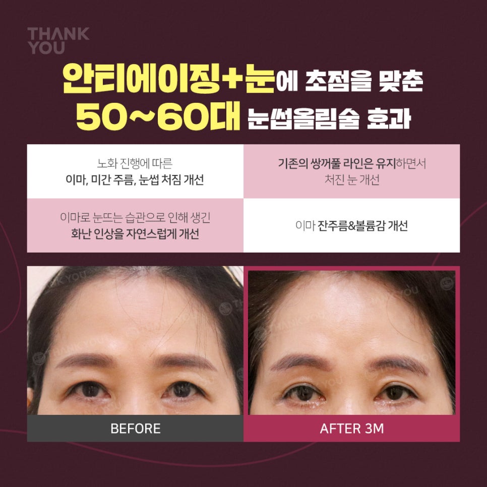 엔도타인 이마거상 찾는다면?시니어&주니어 눈썹올림술 관련 이미지 5