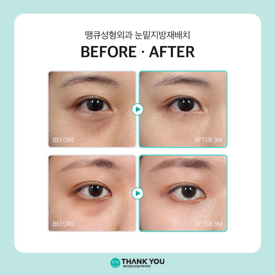 Still Hollow Under the Eyes After Lower Eyelid Fat Repositioning? The Need for Microfat Grafting Under the Eyes image 6