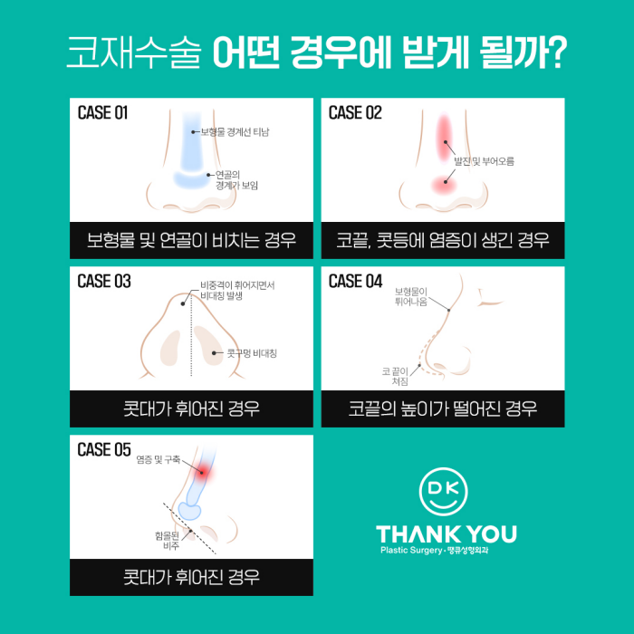 코재수술병원에서 알려주는 재수술하게 되는 이유! 관련 이미지 3