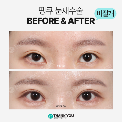 Selection Criteria for Incisional or Non-Incisional Surgery, as Explained by a Specialist in Revision Eyelid Surgery image 11