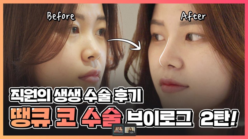 뚱뚱한 코 탈출! 실리콘 코성형👃(직원 코성형 브이로그2탄) 관련 이미지 1