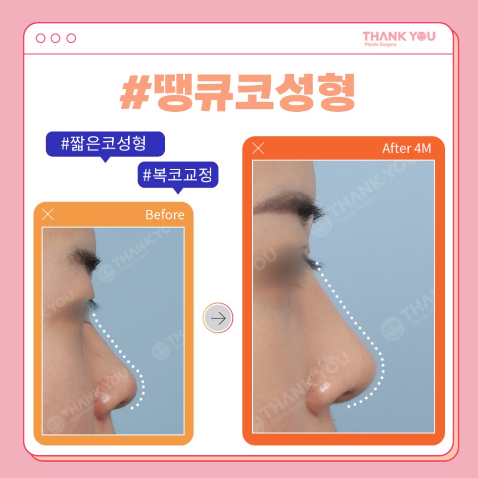 코성형 전후, 코모양 신논현역 성형외과에서 체크 관련 이미지 7