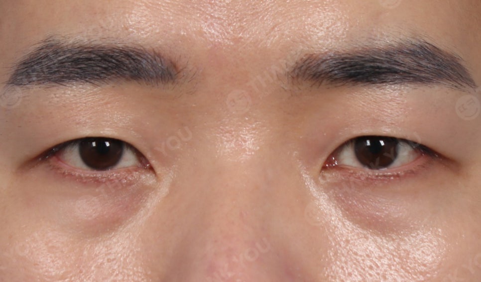 눈밑지방재배치 앞광대 지방이식이 필요한 이유? 관련 이미지 4