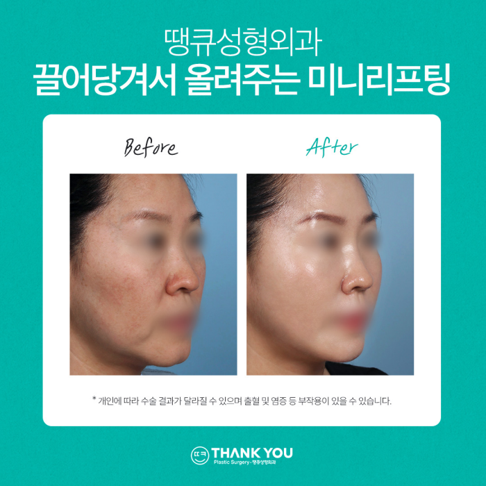 미니리프팅, 탄력과 주름을 동시에 개선하는 동안시술🤗 관련 이미지 11