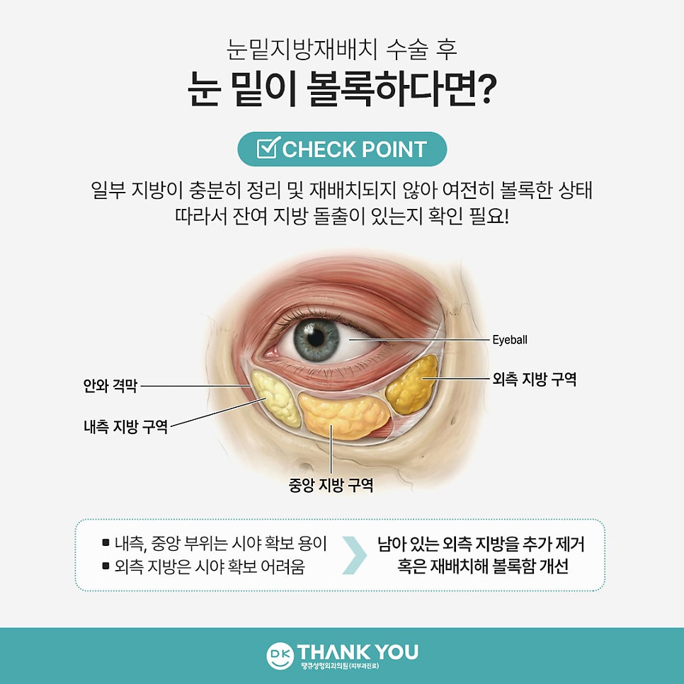 눈밑지방재배치 재발? 수술 후 눈 밑이 볼록한 이유 관련 이미지 3