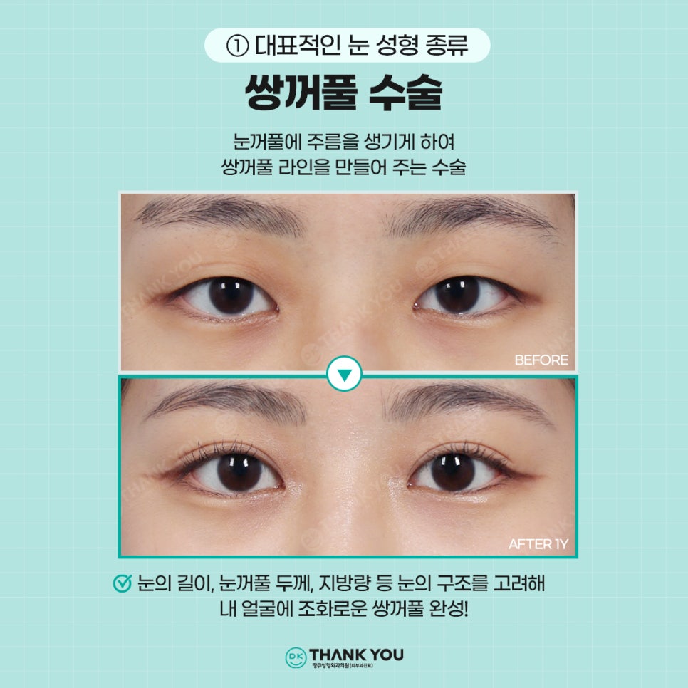 첫눈성형, 자연스럽고 조화로운 결과를 위해서는?! 관련 이미지 2