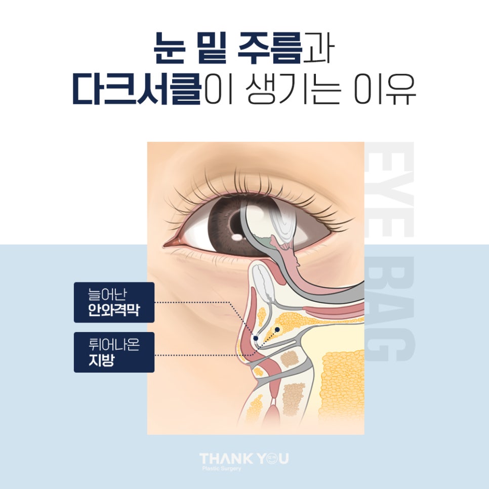 비수술 눈밑성형, 레이저 눈밑지방재배치란? 관련 이미지 2