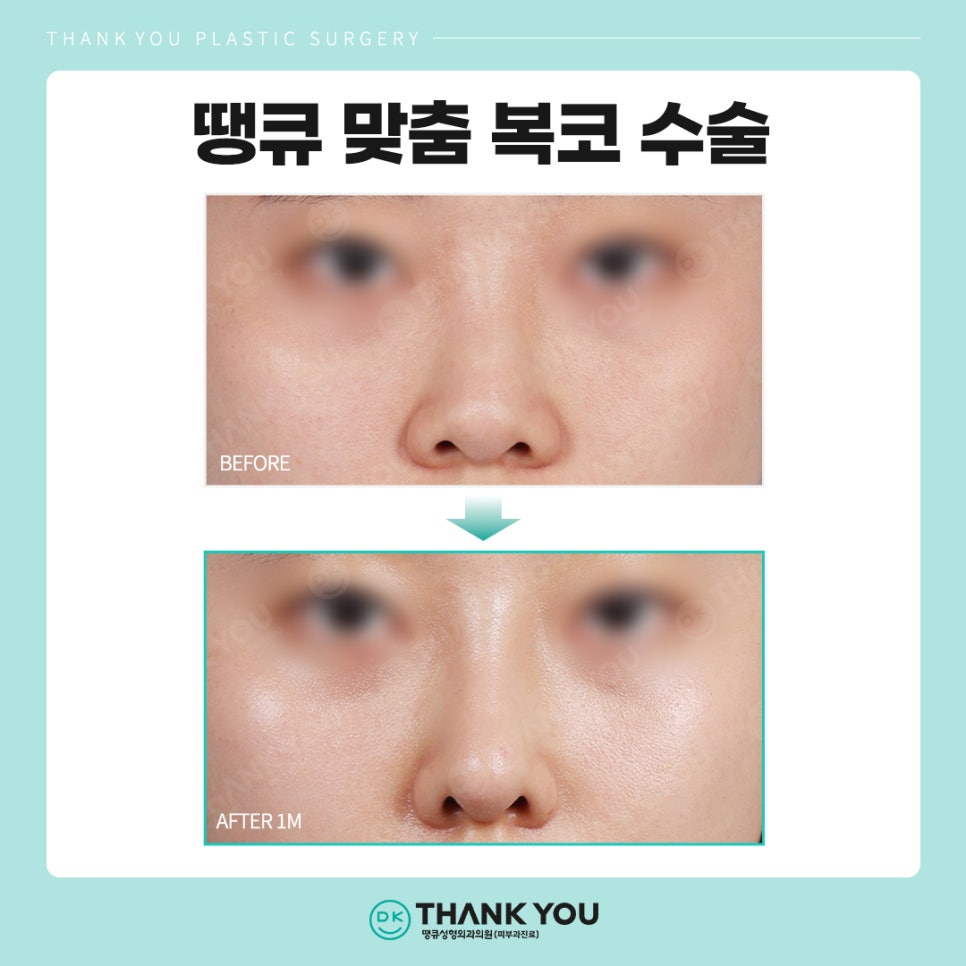 복코수술후기? 세련된 이미지 만드는 땡큐에서 확인! 관련 이미지 7