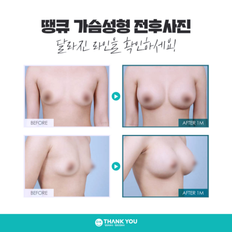 가슴성형보정브라 & 윗밴드 꼭 착용해야 할까요? 관련 이미지 6
