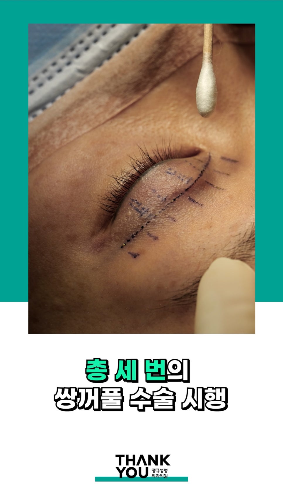 3번 눈재수술? 근데 실제거를 안했다고? 땡큐에서 전부 실제거! 관련 이미지 4