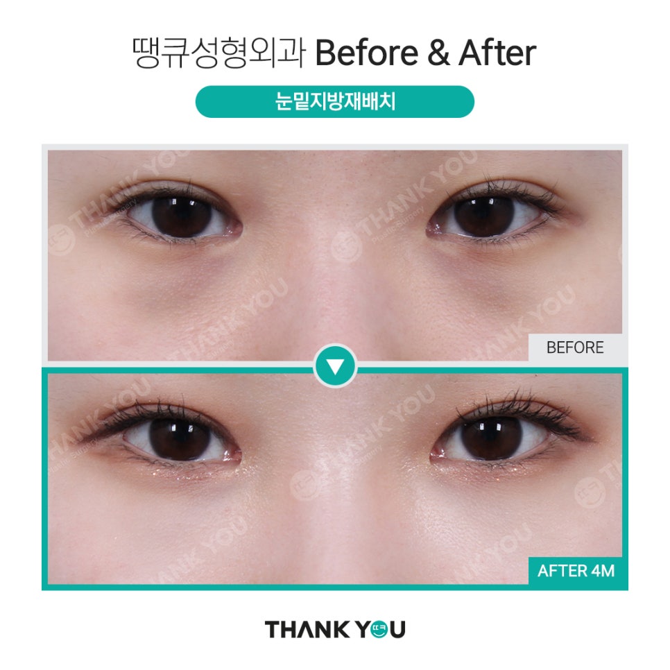 눈밑 필러 넣었는데 눈밑지방재배치 가능할까요? (이호준 칼럼) 관련 이미지 16