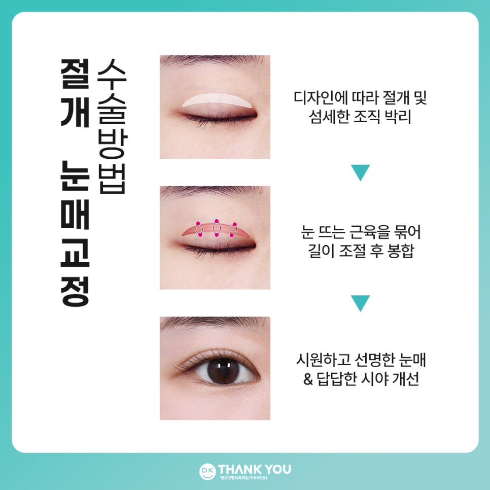 비절개 눈매교정 vs 절개 눈매교정 뭐가 다를까? 관련 이미지 6