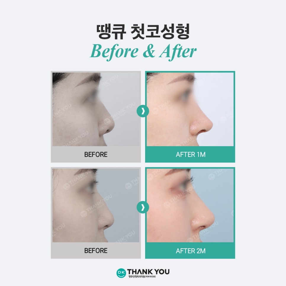 첫코성형 EVENT! 땡큐에서 자연스러운 콧대~코끝 라인 완성! 관련 이미지 6