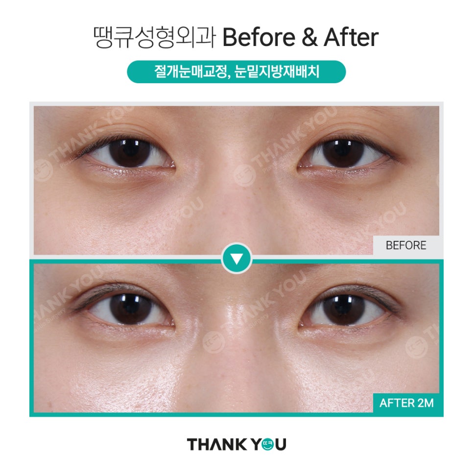 눈밑 필러 넣었는데 눈밑지방재배치 가능할까요? (이호준 칼럼) 관련 이미지 17