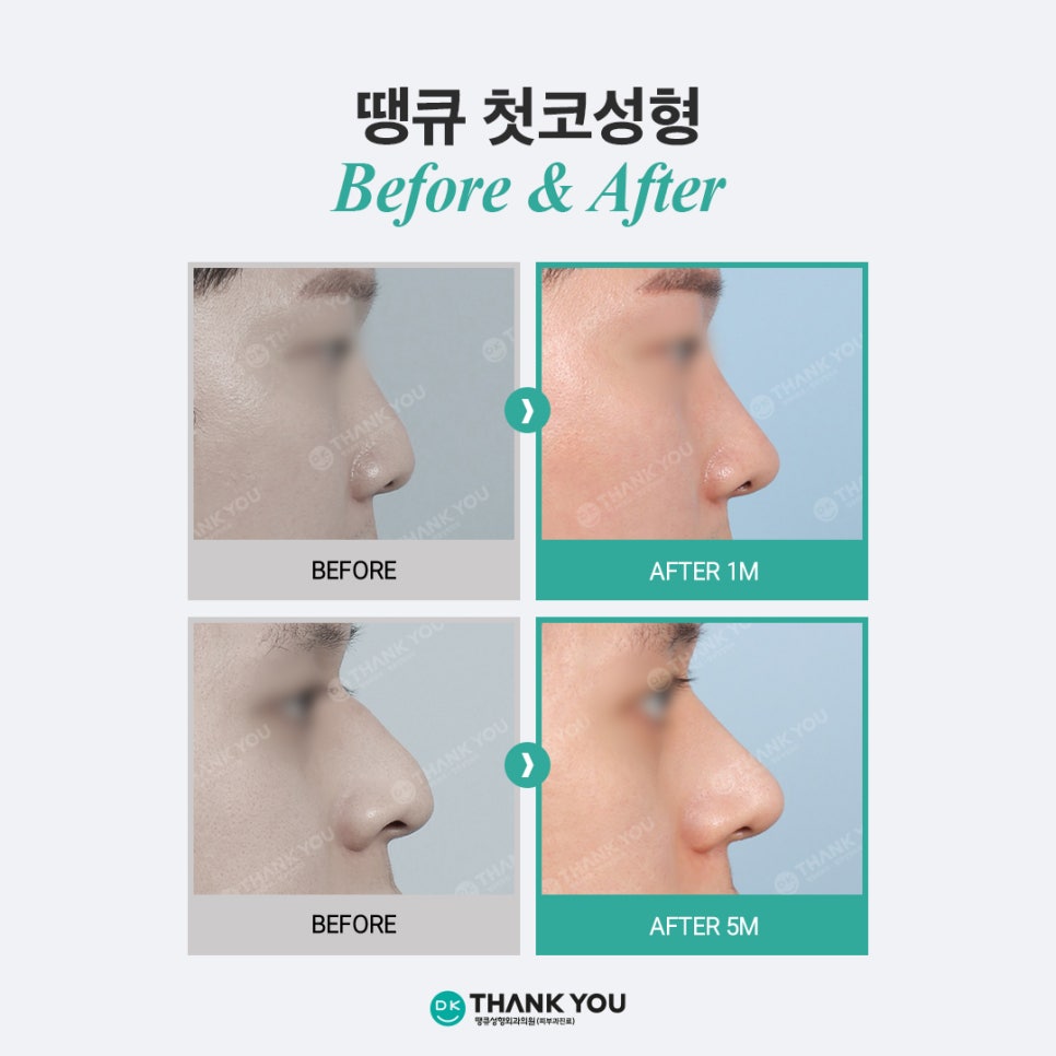 첫코성형 EVENT! 땡큐에서 자연스러운 콧대~코끝 라인 완성! 관련 이미지 7