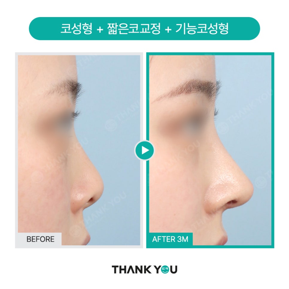 신논현역 성형외과, 남자 휜코성형, 매부리코 성공 포인트는? 관련 이미지 3